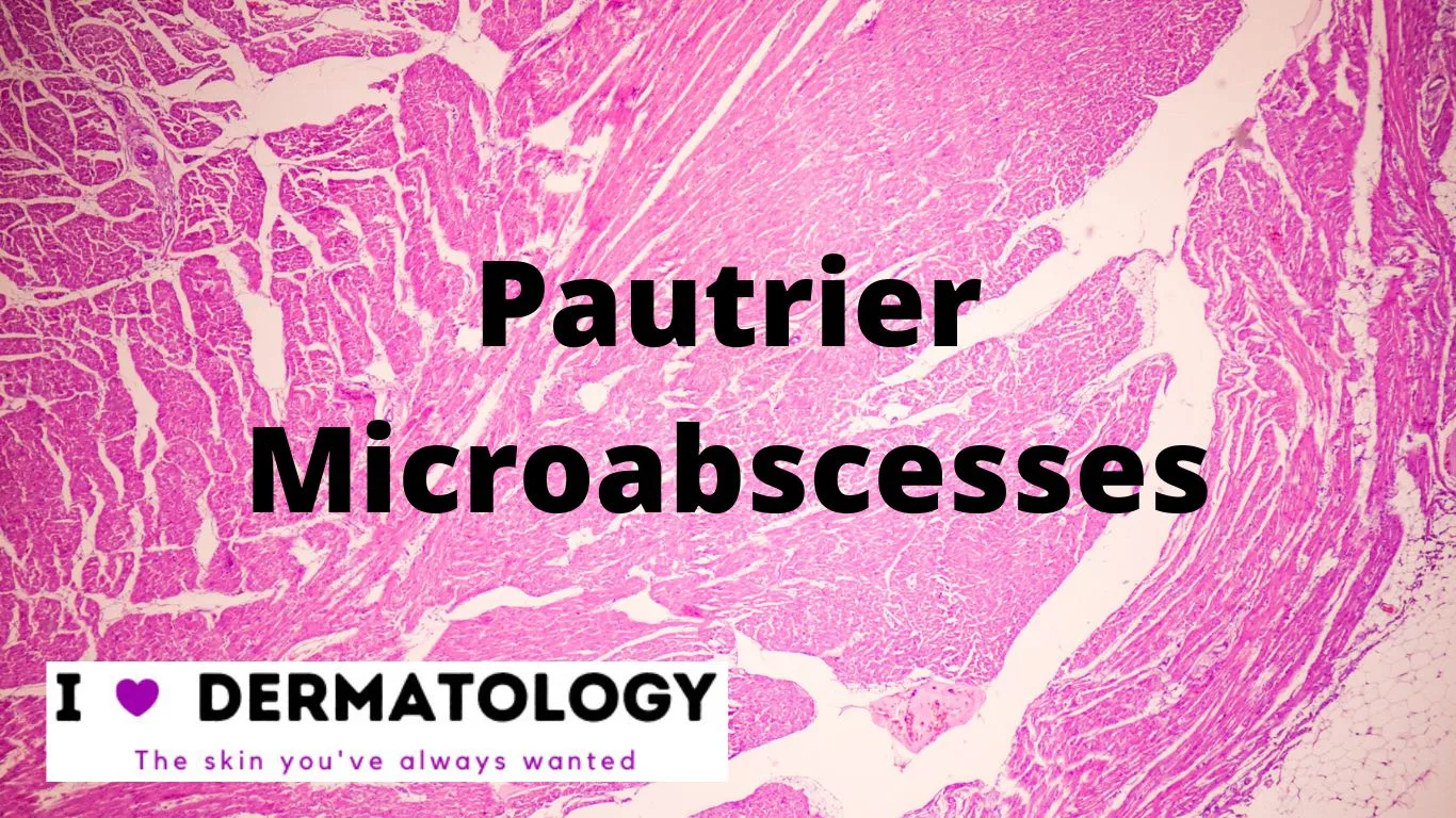 Pautrier Microabscesses