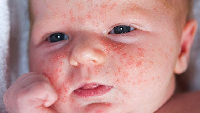 Acne Neonatal: O que é e saiba como cuidar da pele