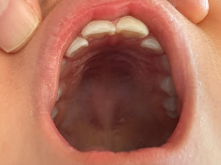 指しゃぶりは4歳までに治すべき！？3歳児検診で引っかかったので小児歯科に行ってきた結果