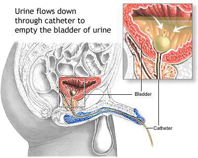 Acute Cystitis (Bladder Infection)