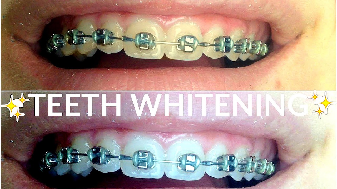 How To Make Your Teeth Whiter When You Have Braces