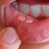 Canker Sores In The Mouth: Here Is How To Naturally Get Rid Of Them In A Matter Of Minutes Without Using Any Medicine