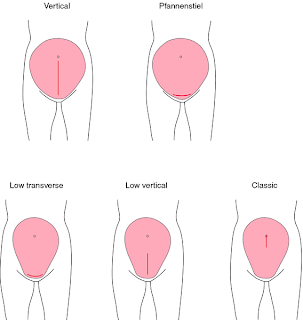 11 Tips Menjaga Luka Bersalin Pembedahan (Cesarean) agar 