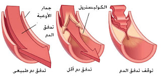 أعراض مرض الكولسترول