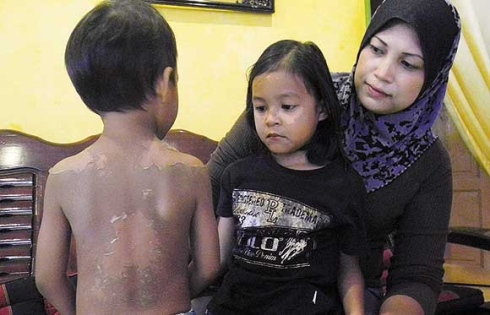 Anak Melecur Kena Air Panas Jangan Sapu Ubat Gigi, Kicap 