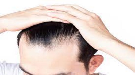 does creatine cause hair loss