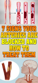 7 SIGNS YOUR ARTERIES ARE BLOCKED AND HOW TO TREAT THEM