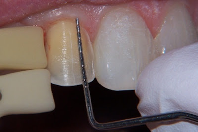  Răng cấm bị mẻ nên làm gì