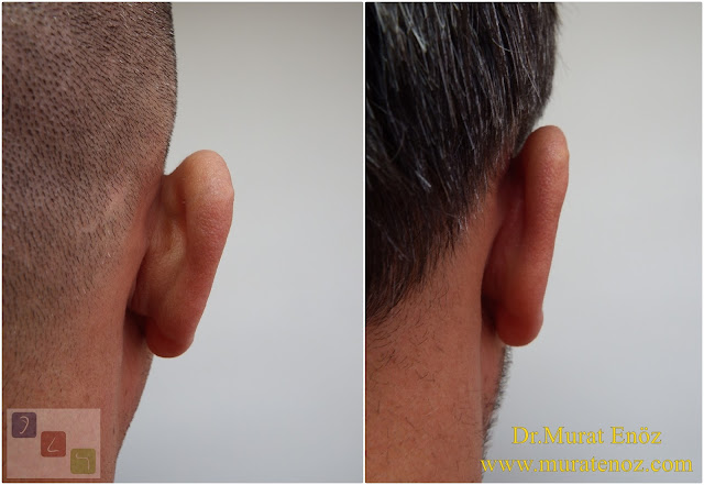 Before and After Photos for Ear Plastic Surgery in Istanbul, Turkey - Ear Plastic Surgery - Protruding Ear Surgery in Istanbul - Modified Technique - Conchomastoid Technique - Otoplasty Operation in Istanbul - Otoplasty Operation in Turkey