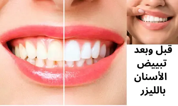 قبل-وبعد-تبييض-الاسنان-بالليزر
