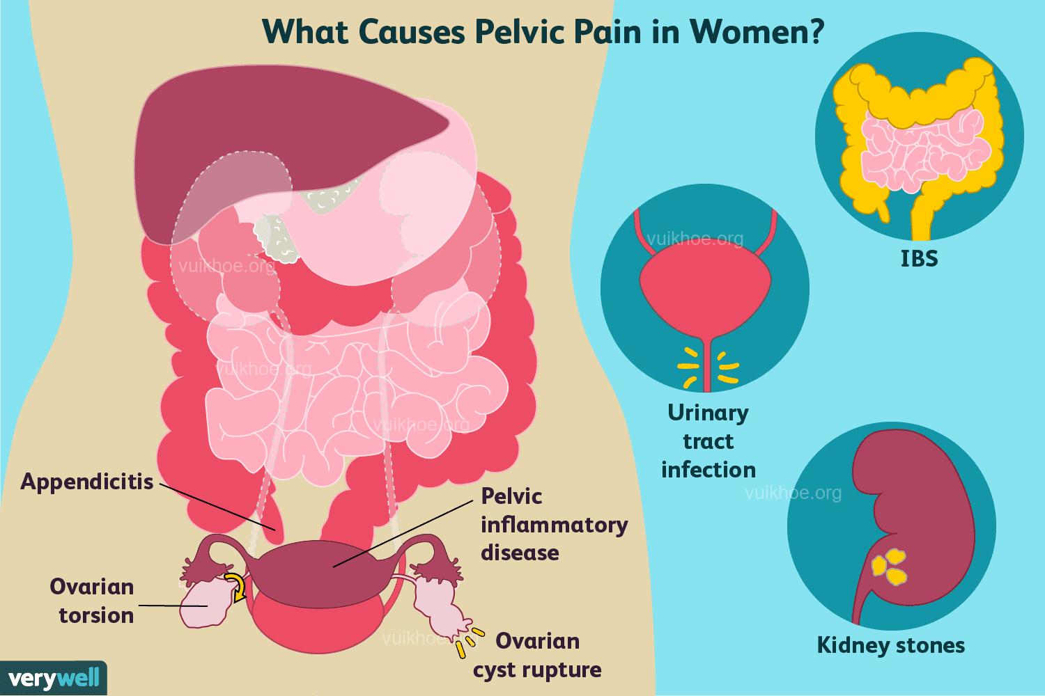 Common causes of pelvic pain in women