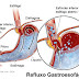  Corset x Refluxo gastroesofágico