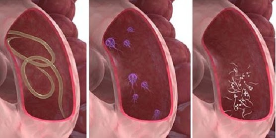 Si sientes estos síntomas significa que tienes los intestinos llenos de parásitos. Mira como puedes deshacerte de ellos de manera natural