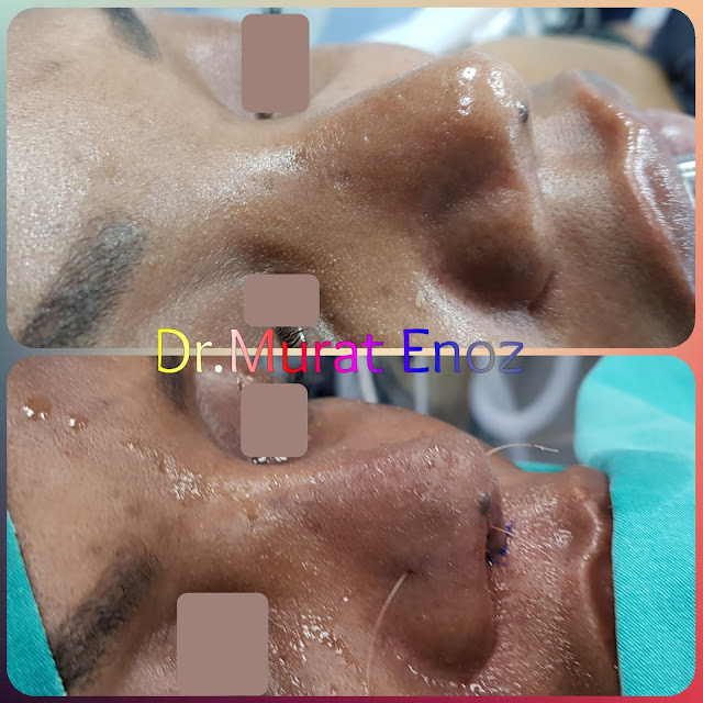 Ethnic revision rhinoplasty in Istanbul