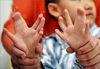 Boy with 31 Fingers and Toes Seen On www.coolpicturegallery.net