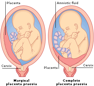 Placenta praevia (low lying placenta) causes picture and more