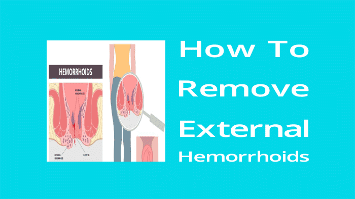 How to remove external hemorrhoids at home
