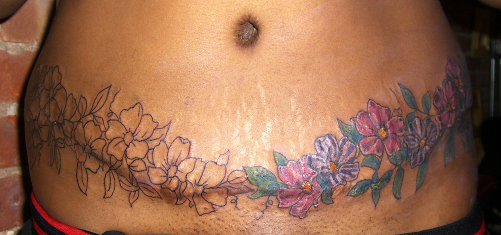 Stretch marks are fine for tattooin over, will dig out a pic for you,