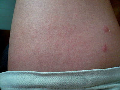 heat rash baby. The hear rashes was all over