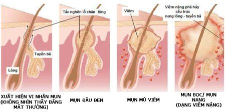 Hướng dẫn trị mụn bọc nhanh nhất hiện nay