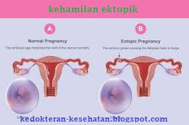  Kehamilan  Ektopik Terganggu Informasi Kedokteran 