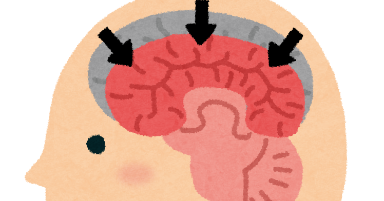認知症の脳のイラスト アルツハイマー型 かわいいフリー素材集 いらすとや