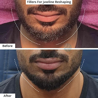 best jawline treatment in Lahore, skincare treatment in lahore