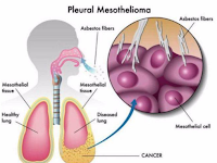 Mesothelioma Cancer: Mesothelioma Cancer Treatment Possibilites