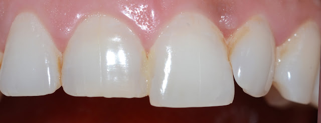 One Central Incisor is Short Compared to Adjacent
