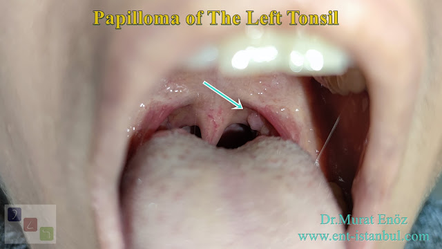 tonsil papilloma