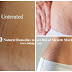 10 Natural Remedies to Get Rid of Stretch Marks Fast