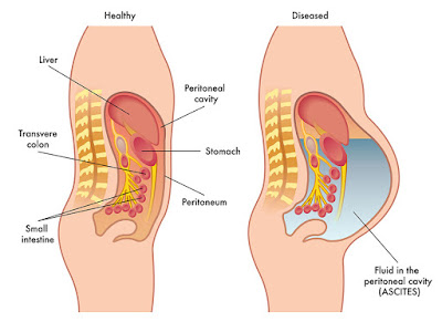 abdominal-swelling-ascites