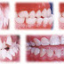 Phương pháp chỉnh nha cho răng lệch lạc