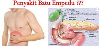 Penyebab Radang Batu Empedu & Obat Radang Batu Empedu Alami