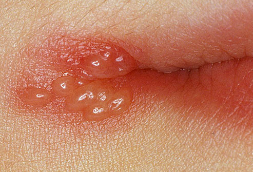 herpes pictures. herpes mouth sores pictures.