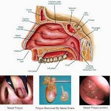 Cara Mengobati Penyakit Polip Hidung