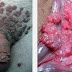 Obat Tradisional Penghilang Kutil Kelamin DiKota Mataram thumbnail