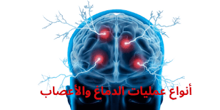 أنواع عمليات الدماغ والأعصاب: الأورام والجلطات الدموية وتمدد الأوعية الدموية