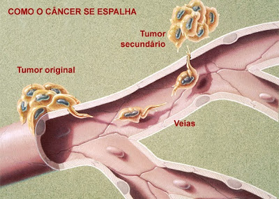 Como o câncer se espalha