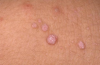 Những dấu hiệu bệnh mụn cóc trên da