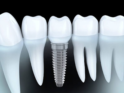 Quy trình cấy ghép răng implant an toàn