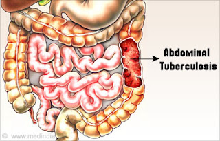 TBC Usus dan Pengobatannya