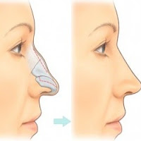 Houston rhinoplasty