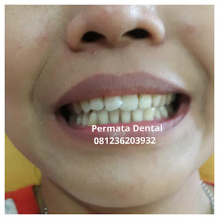 gambar foto behel bracket kawat gigi sebelum dan sesudah perawatan untuk memperbaiki merapikan gigi gingsul gigi miring renggang tonggos berantakan keluar masuk jarang diastema maju mundur tidak rapi tidak beraturan bali denpasar banyuwangi jember tidak rata kocar kacir