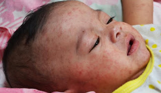 Measles Symptoms Baby