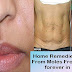 4 Effective Home Remedies To Get Rid From Black & Brown Moles On FaceBody