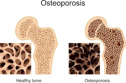 Risk Factors Of Osteoporosis
