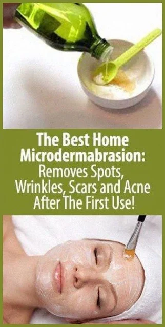 The Best Home Microdermabrasion: Removes Spots, Wrinkles, Scars and Acne After The First Use!