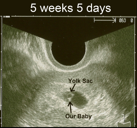 Images Of 5 Weeks Pregnant. 5 1/2 and 6 weeks pregnant