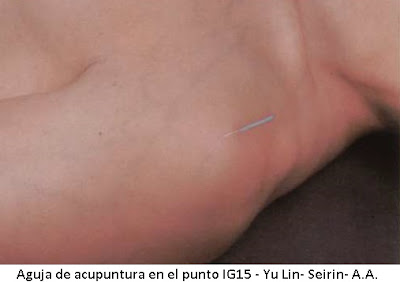 acupuntura para hombro doloroso - bursitis